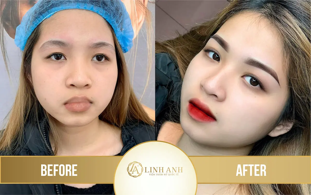 Xăm môi màu đỏ cherry - Viện thẩm mỹ quốc tế Linh Anh