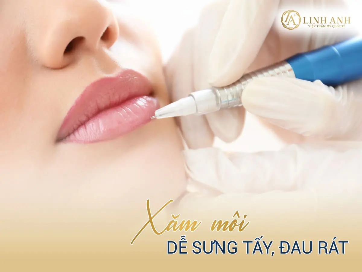 Tại sao môi trên bị thâm - Viện thẩm mỹ quốc tế Linh Anh