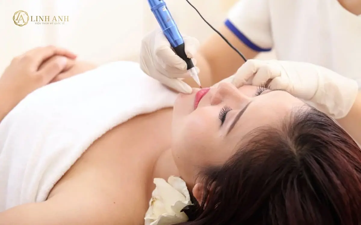 Xoá xăm môi bằng laser - Viện thẩm mỹ quốc tế Linh Anh
