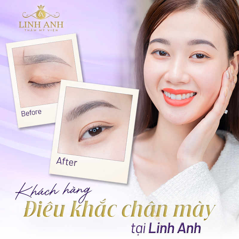 Hậu quả điêu khắc lông mày hỏng