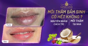 môi thâm bẩm sinh có hết không