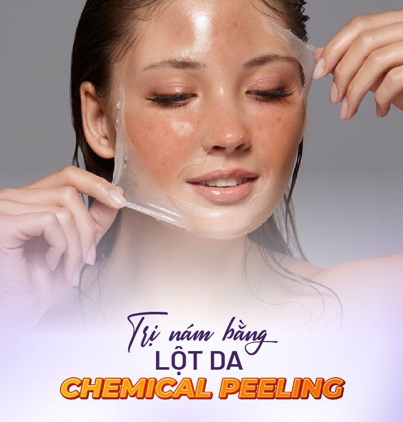 trị nám bằng chemical peeling