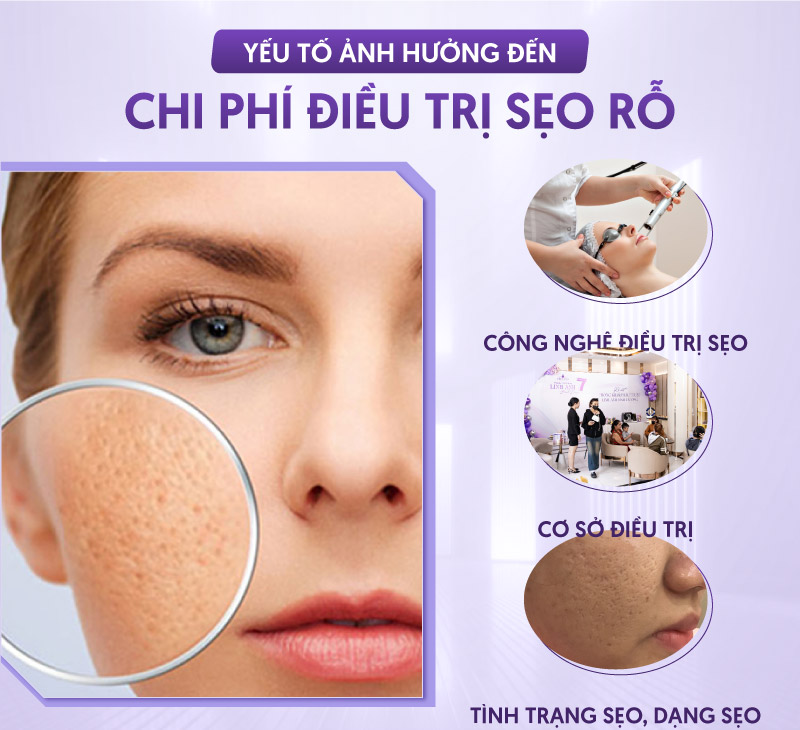 chi phí điều trị sẹo rỗ chi phí điều trị sẹo rỗ