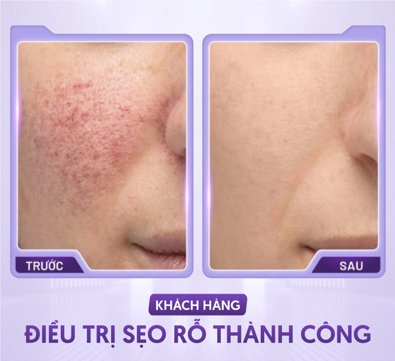 giá trị sẹo rỗ