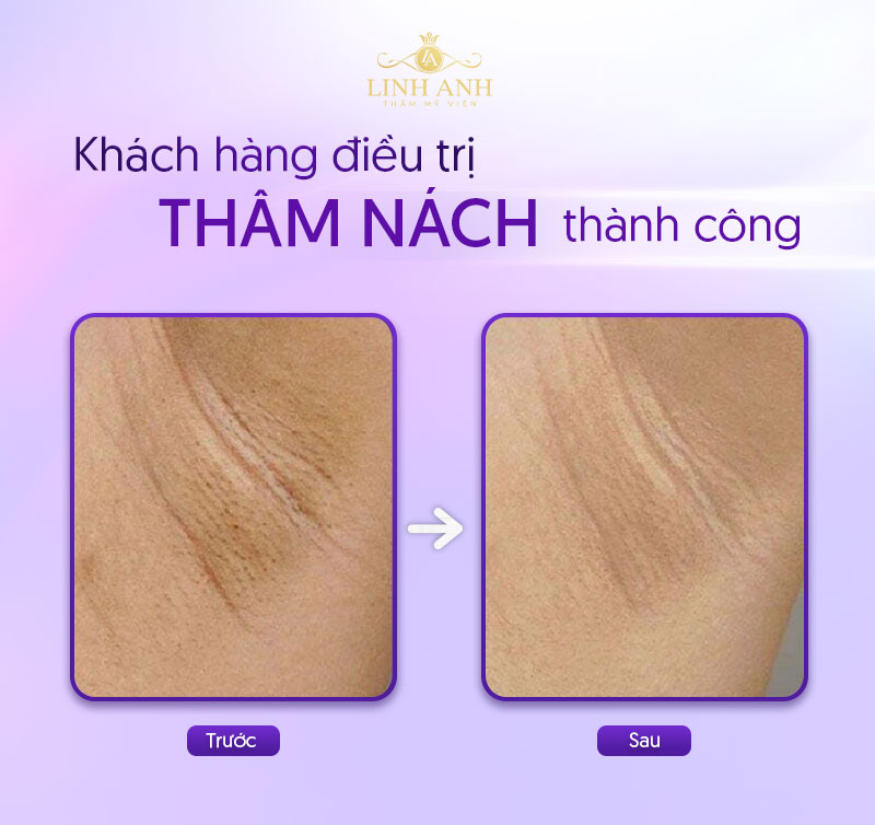 khử thâm nách bao nhiêu tiền khử thâm nách bao nhiêu tiền