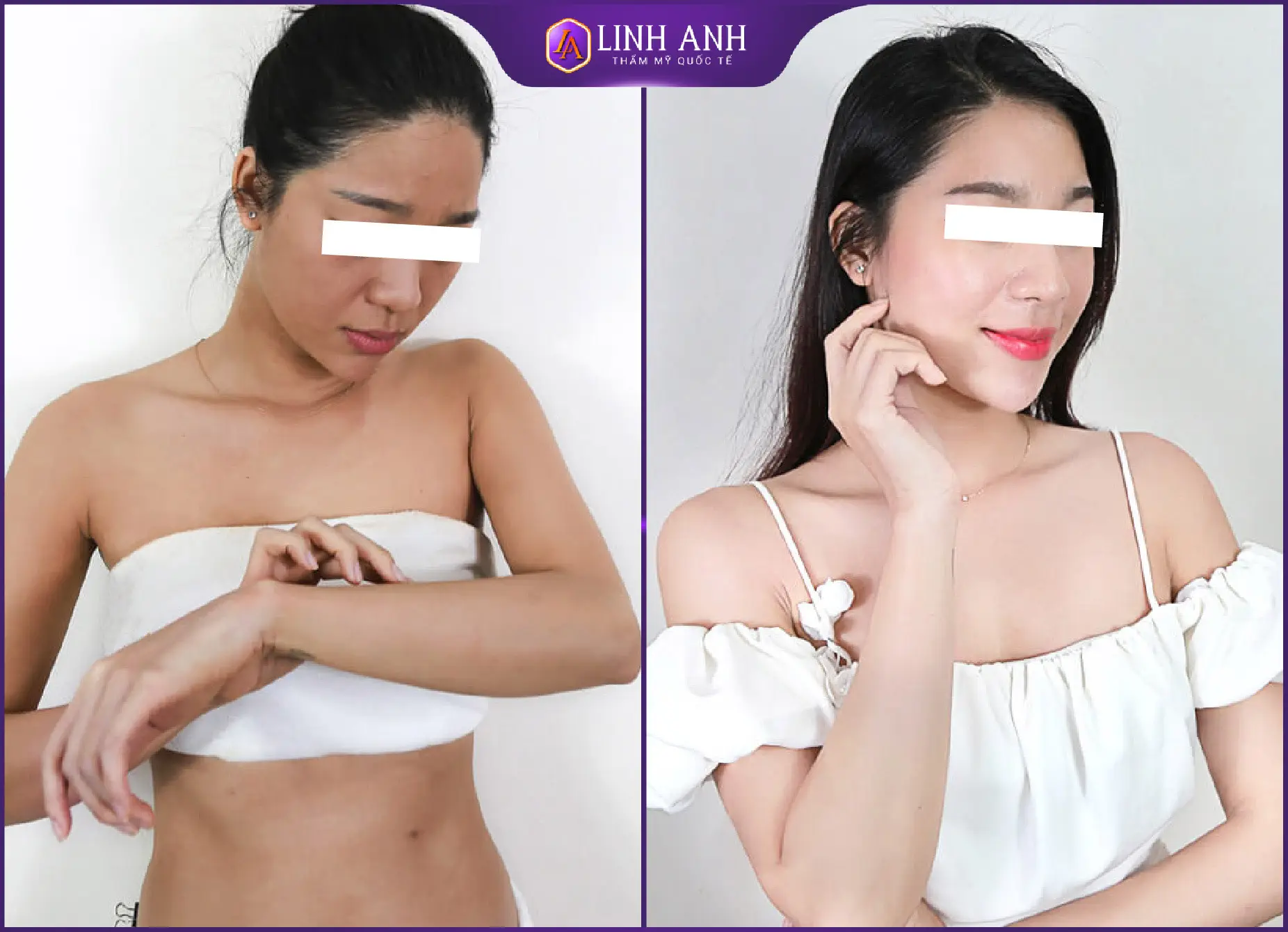 Chị Tuyết Nhung (34 tuổi) Tắm trắng Collagen Body Trước: Da sạm màu, khô sần, nhiều đốm nâu vùng bụng và cánh tay.<br> Sau: Xoá sổ đốm nâu, thâm sạm. Thay da mới trắng hồng, mịn màng, căng mướt.