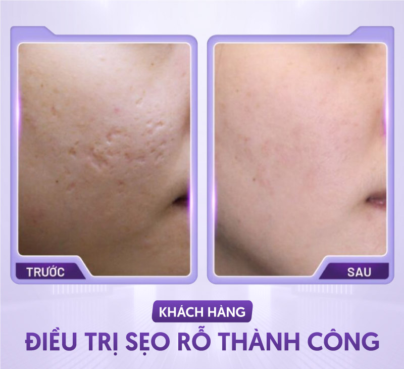 Liệu Trình Trị Sẹo Rỗ Bao Nhiêu Tiền