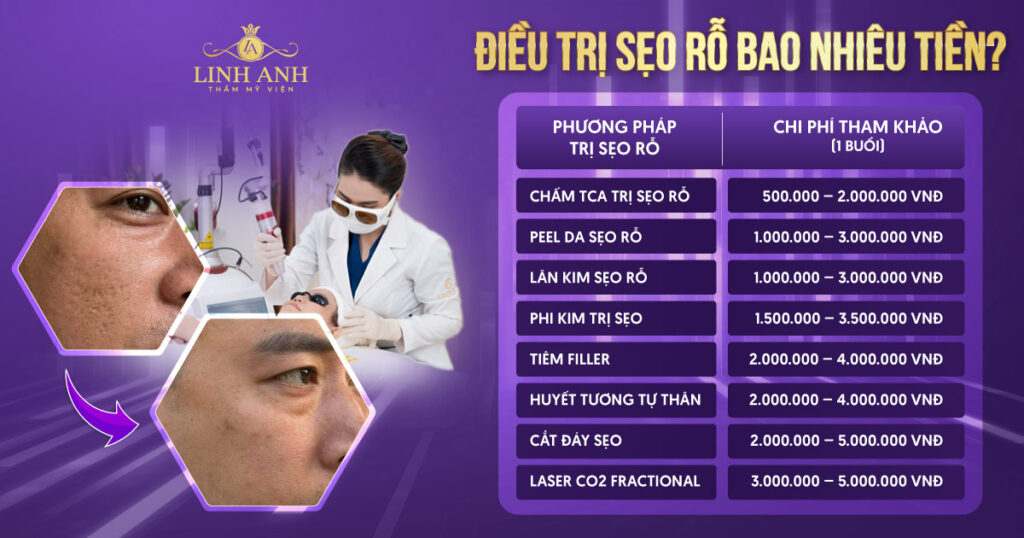 trị sẹo rỗ bao nhiêu tiền
