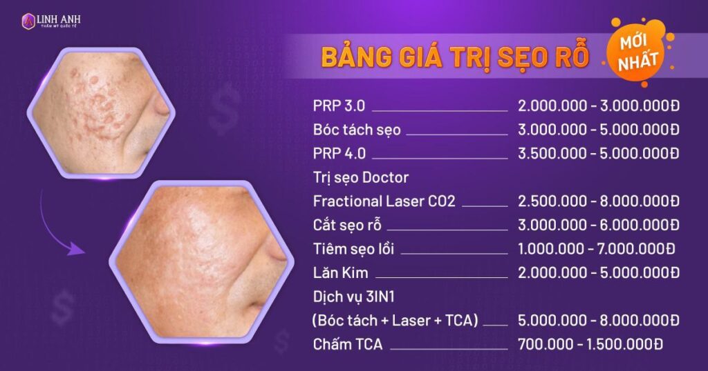 trị sẹo rỗ bao nhiêu tiền - Viện thẩm mỹ quốc tế Linh Anh