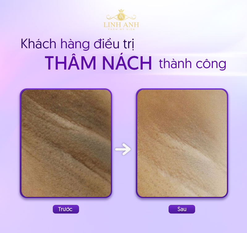 trị thâm nách giá bao nhiêu trị thâm nách giá bao nhiêu