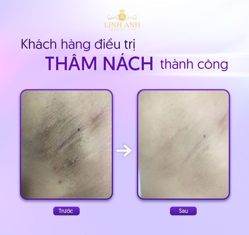 trị thâm nách hết bao nhiêu tiền trị thâm nách hết bao nhiêu tiền