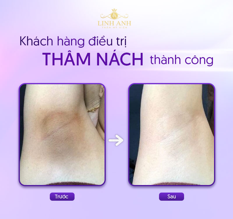 trị thâm nách spa trị thâm nách spa