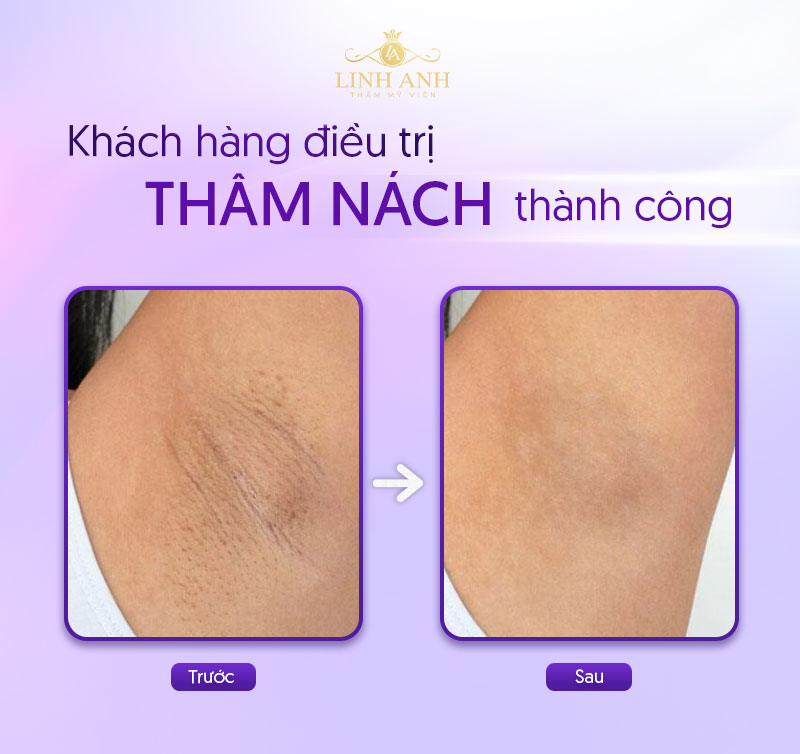 trị thâm nách tại spa trị thâm nách tại spa