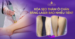xoá sẹo thâm ở chân bao nhiêu tiền