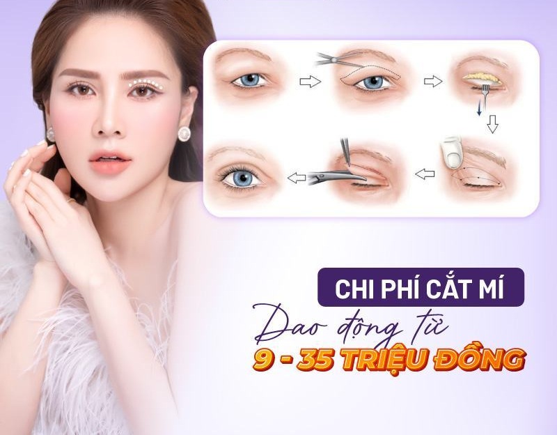 cắt mí giá bao nhiêu cắt mí giá bao nhiêu
