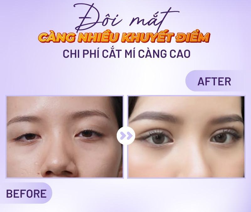 chi phí cắt mí mắt chi phí cắt mí mắt