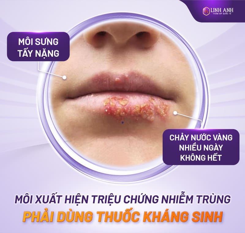 Sau khi phun môi có phải uống thuốc kháng sinh không - Viện thẩm mỹ quốc tế Linh Anh