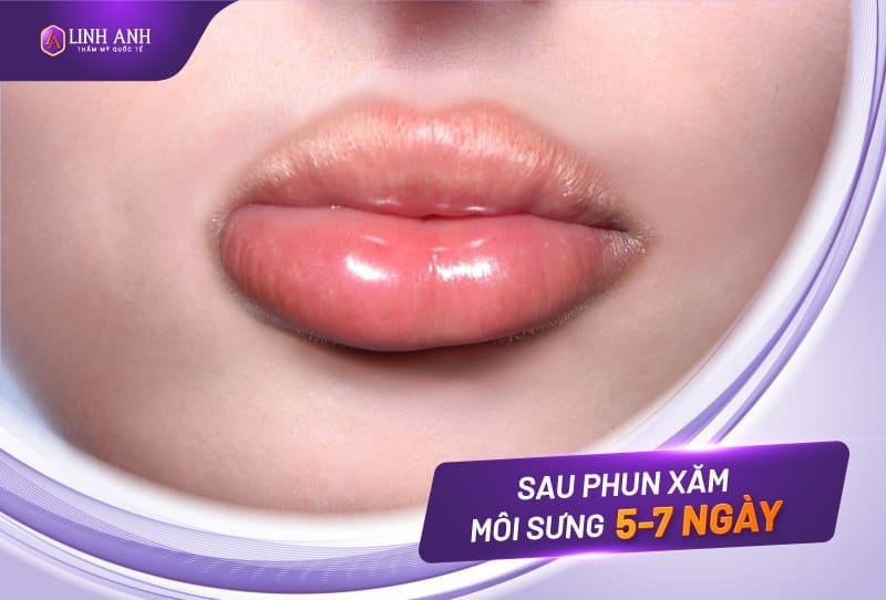Sau khi phun môi có phải uống thuốc kháng sinh - Viện thẩm mỹ quốc tế Linh Anh