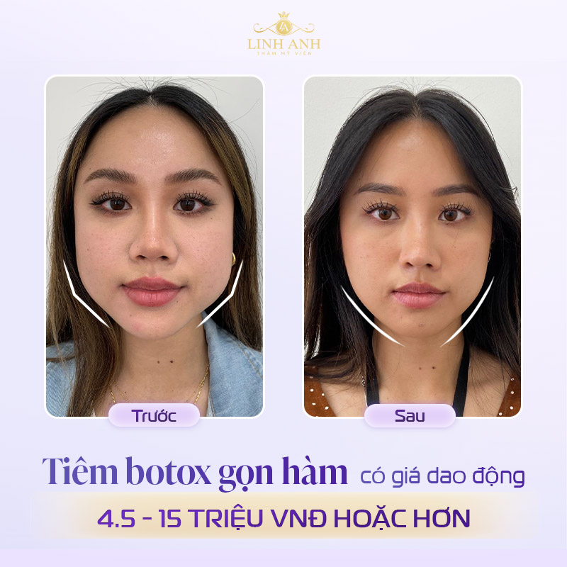 Tiêm botox gọn hàm bao nhiêu tiền