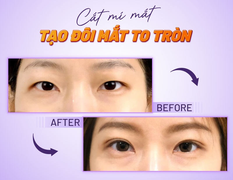 bảng giá cắt mí mắt bảng giá cắt mí mắt