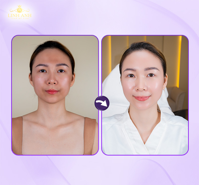 bảng giá tái sinh đa Tầng