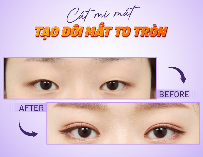 cắt mí hết bao nhiêu tiền cắt mí hết bao nhiêu tiền