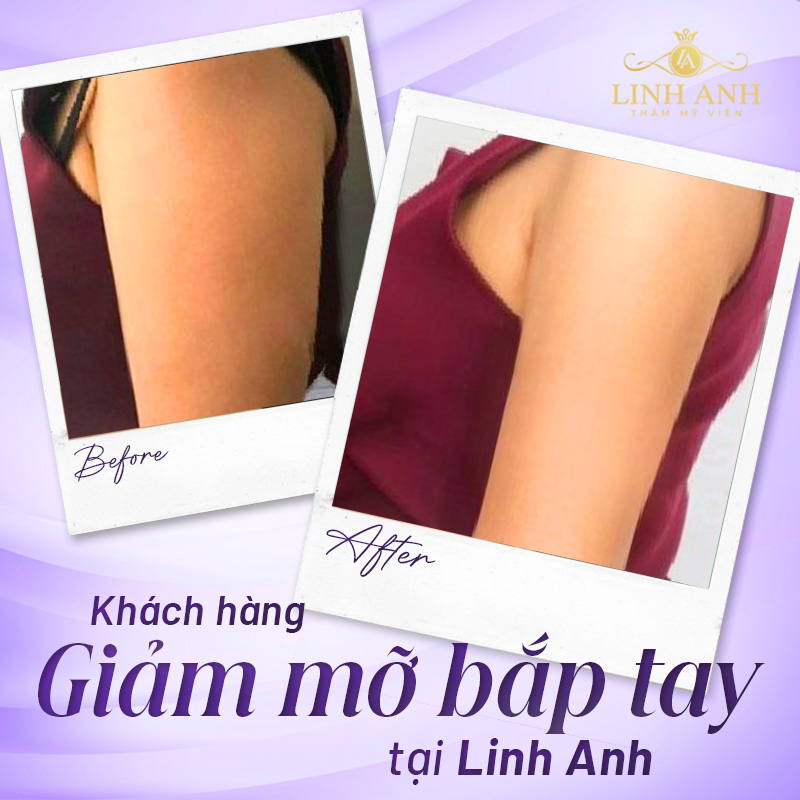 giảm mỡ bắp tay cấp tốc