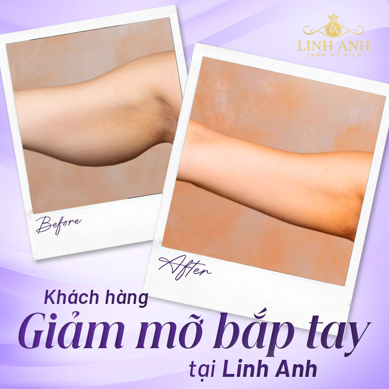 làm sao để bắp tay nhỏ lại