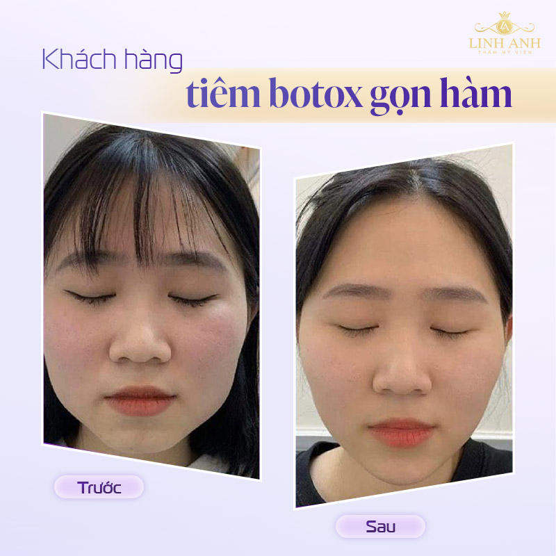 Review dịch vụ tiêm botox gọn hàm