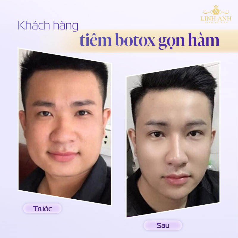 Review tiêm botox gọn hàm