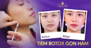 tiêm botox gọn hàm giá bao nhiêu