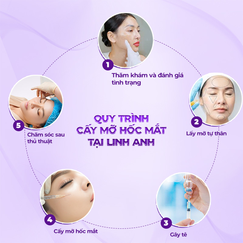 cấy mỡ hốc mắt giá bao nhiêu tiền