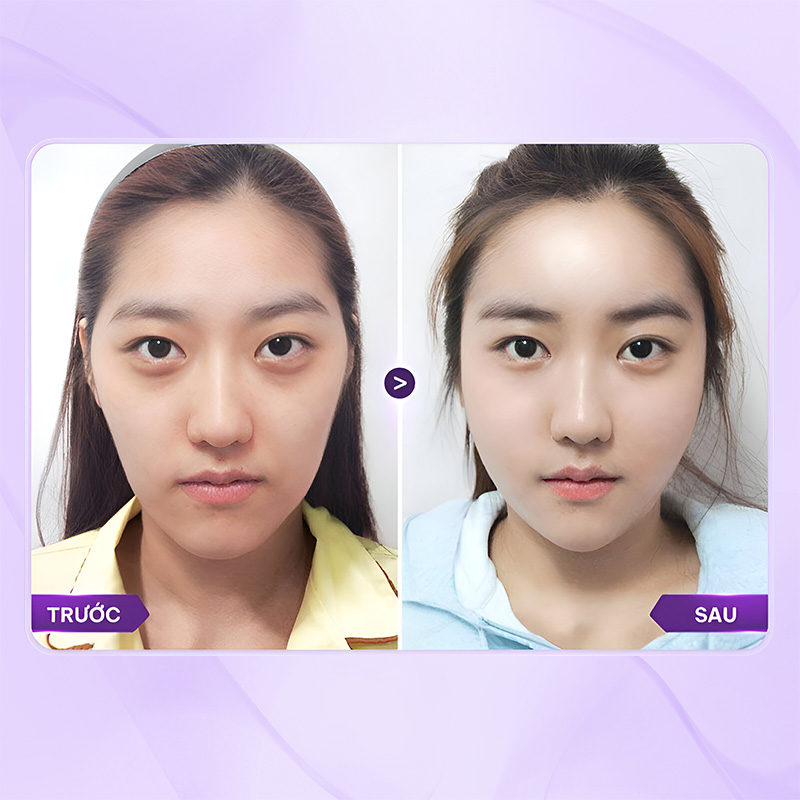 chi phí cấy mỡ hốc mắt bao nhiêu