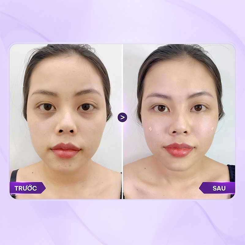 chi phí cấy mỡ hốc mắt mới nhất