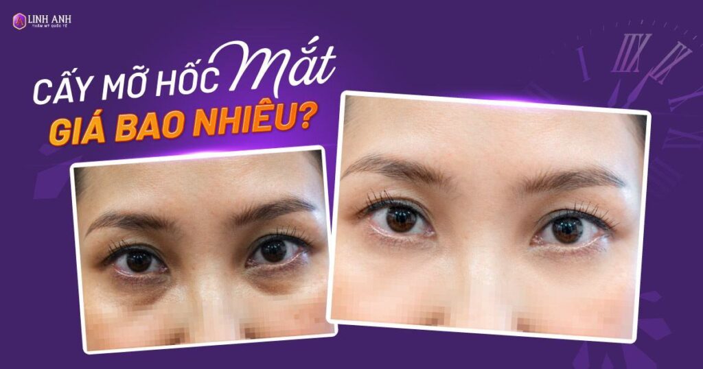 cấy mỡ hốc mắt giá bao nhiêu - Viện thẩm mỹ quốc tế Linh Anh