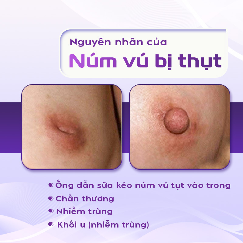 chi phí kéo núm vú bị tuột chi phí kéo núm vú bị tuột