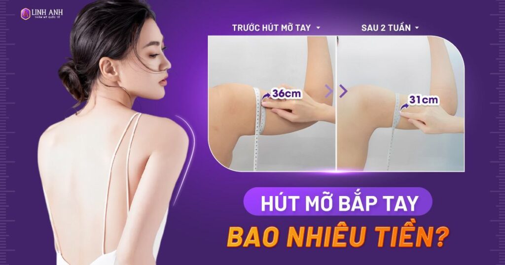 hút mỡ bắp tay bao nhiêu tiền - Viện thẩm mỹ quốc tế Linh Anh