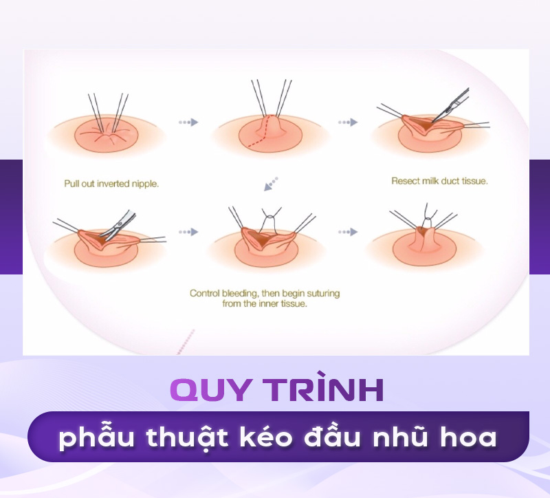 kéo núm vú tụt bao nhiêu tiền
