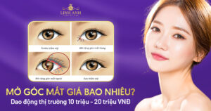 mở góc mắt giá bao nhiêu