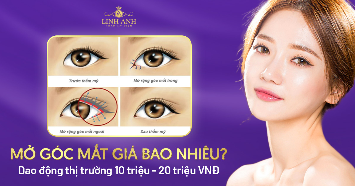 mở góc mắt giá bao nhiêu