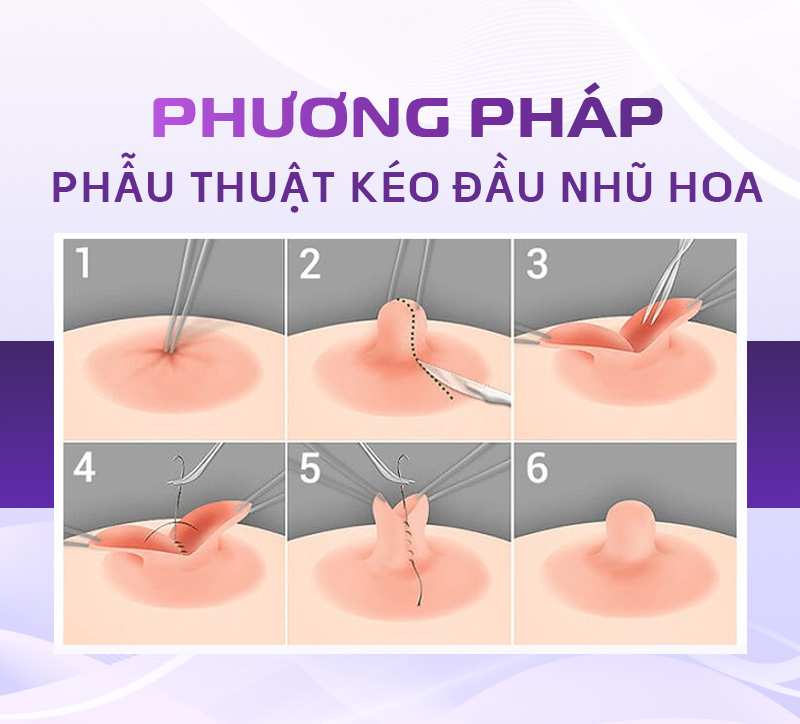 phẫu thuật tụt núm vú giá bao nhiêu phẫu thuật tụt núm vú giá bao nhiêu