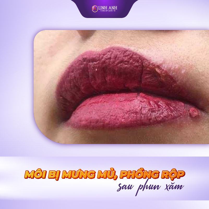 Xăm môi bị sưng  Nguyên nhân và cách khắc phục nhanh chóng  Long huyết PH  tan bầm tím giảm sưng đau