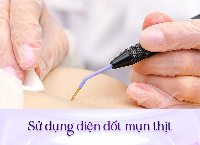bắn laser mụn thịt giá bao nhiêu bắn laser mụn thịt giá bao nhiêu