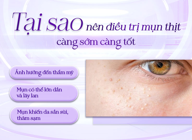 bắn mụn thịt bao nhiêu tiền bắn mụn thịt bao nhiêu tiền