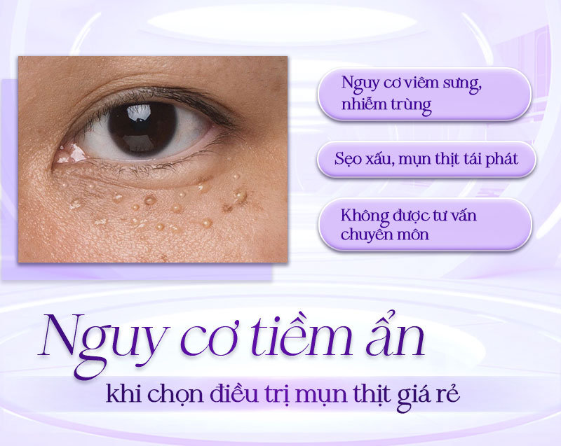 chi phí đốt mụn thịt chi phí đốt mụn thịt