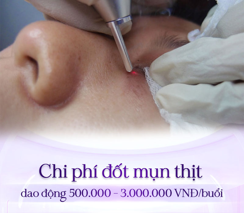 đốt mụn thịt bao nhiêu tiền đốt mụn thịt bao nhiêu tiền
