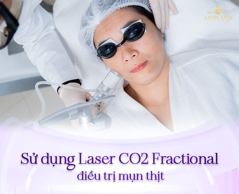 giá bắn mụn thịt giá bắn mụn thịt