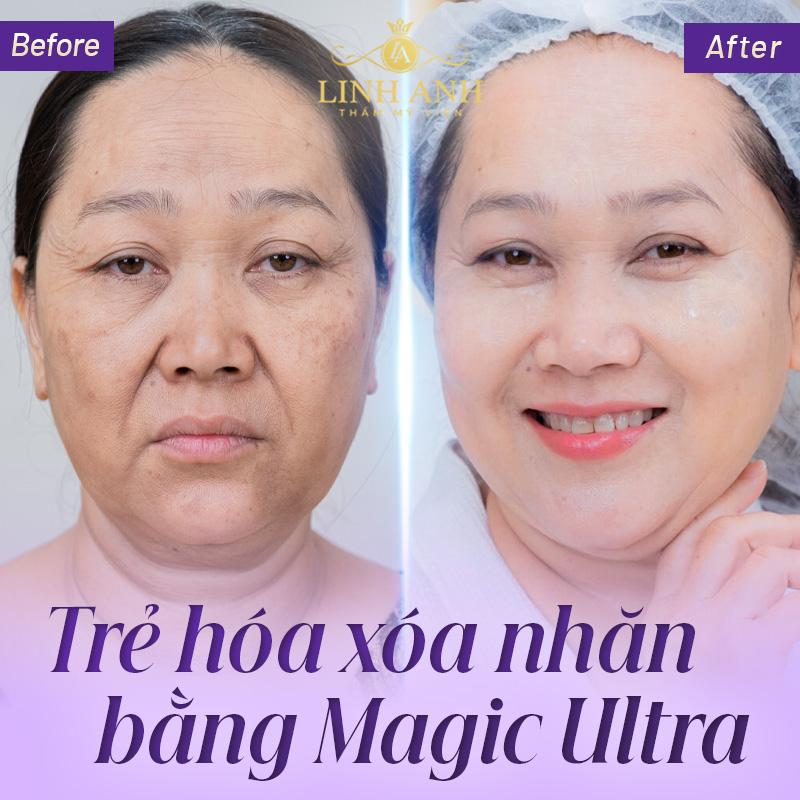 magic ultra tai Linh Anh