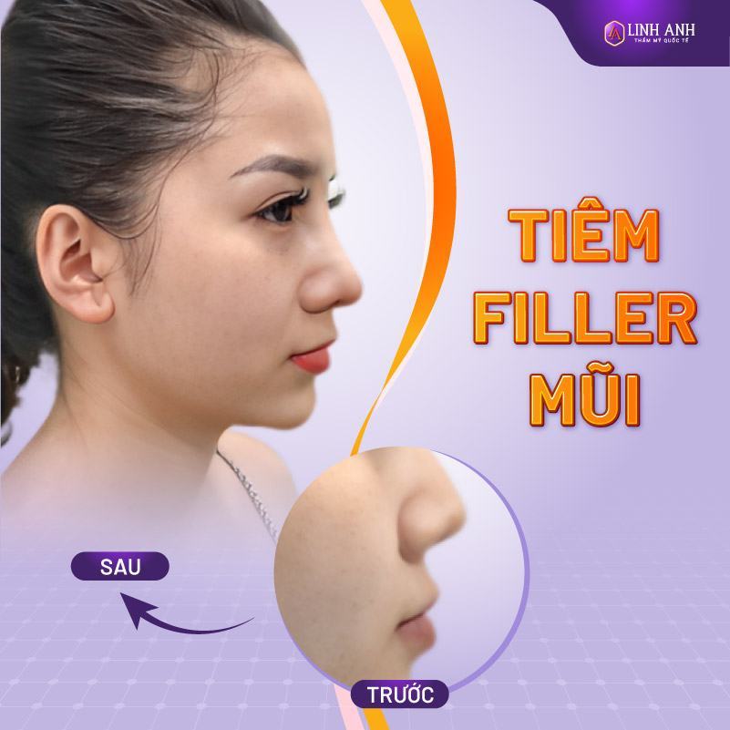 mũi tiêm filler