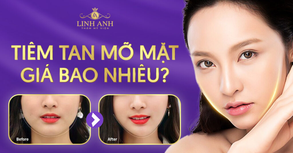 tiêm tan mỡ mặt giá bao nhiêu